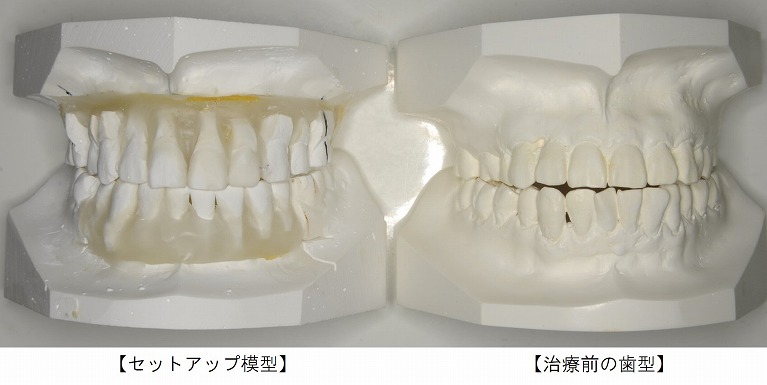 セットアップ模型_症例1_1