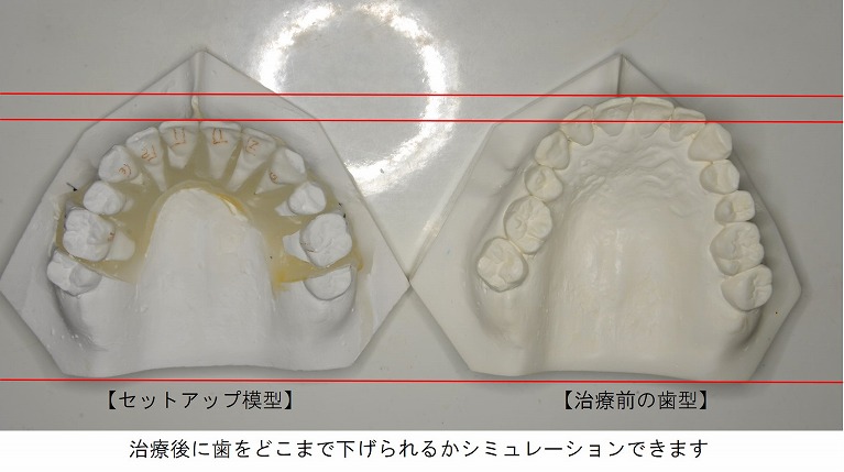 セットアップ模型_症例1_2