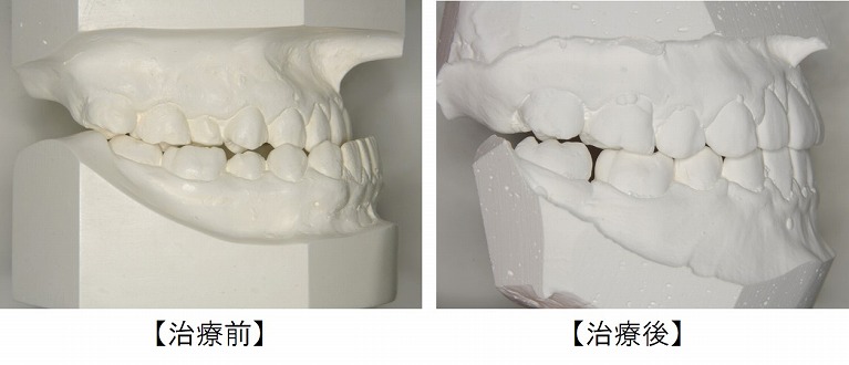 今回の治療した際の歯型（治療前と治療後）
